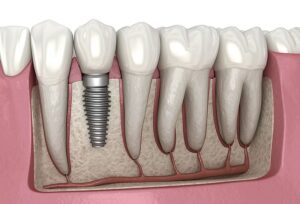 Asia Pacific Dental Implants Market