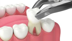 wisdom tooth removed