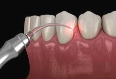Captureperiodontist laser gum treatment