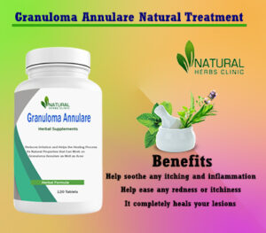 Granuloma Annulare Herbal Remedies