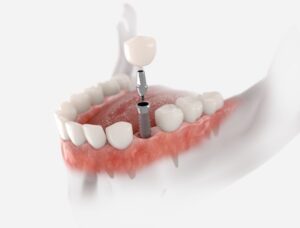 How-To-Prepare-Yourself-for-a-Dental-Implant-Surgery