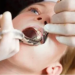 Teeth Extractions NYC