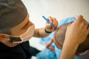 best hair transplant surgeon in Delhi