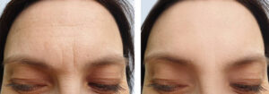 Laser Skin Resurfacing