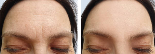 Laser Skin Resurfacing