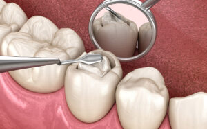 dental fillings houston